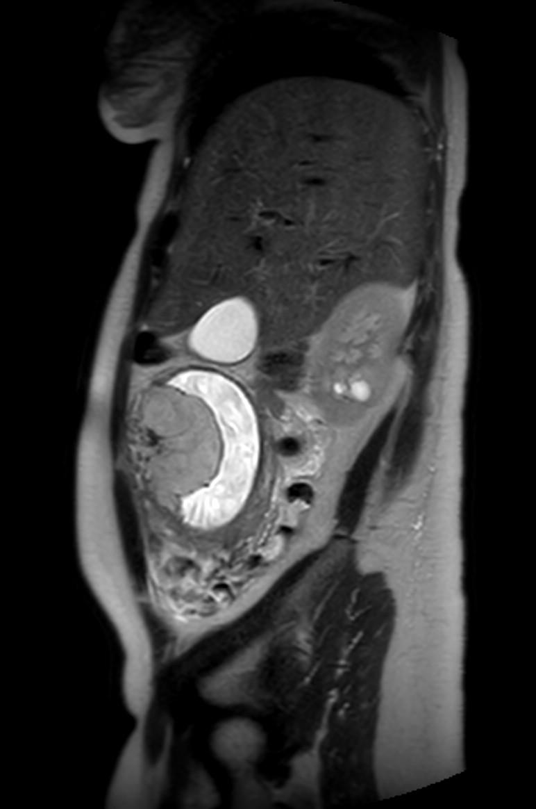 Appendicitis in gravida (MRI) (Radiopaedia 89433-106395 Sagittal T2 50).jpg