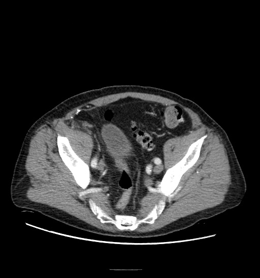 File:Appendicitis with localized perforation and abscess formation (Radiopaedia 49035-54130 A 72).jpg
