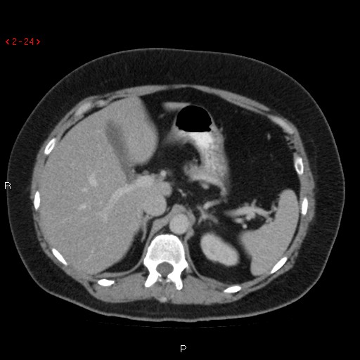 Appendicitis with microperforation- promontoric type (Radiopaedia 27268-27442 C 12).jpg