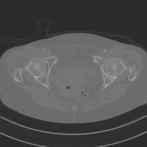 April fools' 2019- calcified peritoneal arachnoidosis (Radiopaedia 67273-76636 Axial bone window 55).png