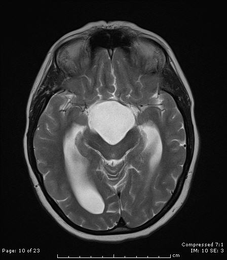 File:Arachnoid cyst distorting the third ventricle (Radiopaedia 6111-7583 Axial T2 1).jpg