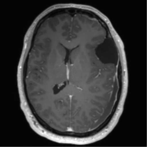 Arachnoid cyst with subdural hematoma (Radiopaedia 85892-101743 Axial T1 C+ 49).png