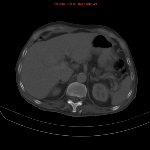 File:Arachnoiditis ossificans (Radiopaedia 51394-57136 Axial bone window 7).jpg