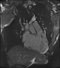 File:Arrhythmogenic right ventricular cardiomyopathy (Radiopaedia 57972-64966 CINE R2 SSFP 45).jpg