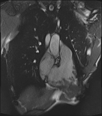 File:Arrhythmogenic right ventricular cardiomyopathy (Radiopaedia 57972-64966 CINE R2 SSFP 99).jpg