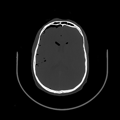File:Arrow injury to the brain (Radiopaedia 72101-82607 Axial bone window 74).jpg
