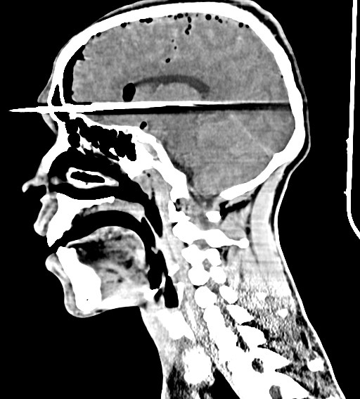Arrow injury to the brain (Radiopaedia 72101-82607 H 37).jpg