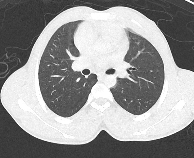 Arrow injury to the chest (Radiopaedia 75223-86321 Axial lung window 32).jpg