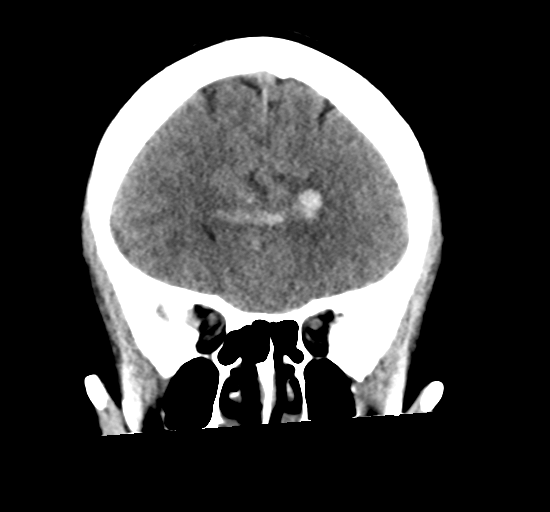 File:Arteriovenous malformation (cerebral) (Radiopaedia 40070-42579 Coronal non-contrast 12).png