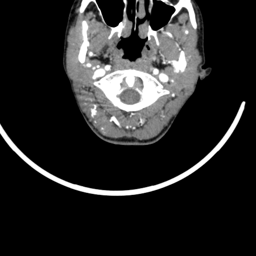 Arteriovenous malformation of the neck (Radiopaedia 53935-60062 A 59).jpg