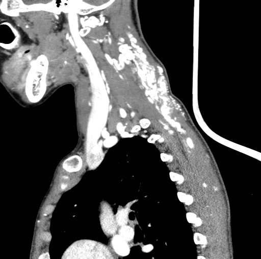 Arteriovenous malformation of the neck (Radiopaedia 53935-60062 C 37).jpg
