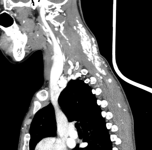 Arteriovenous malformation of the neck (Radiopaedia 53935-60062 C 40).jpg