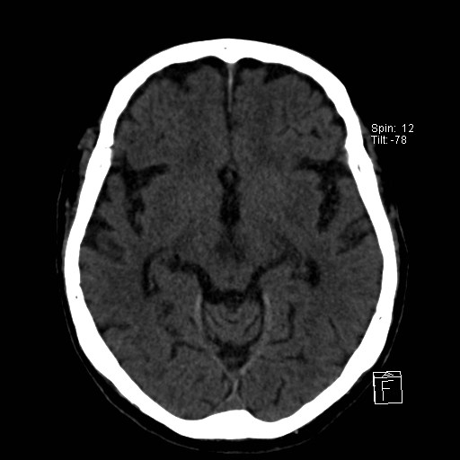 File:Artery of Percheron infarction (Radiopaedia 26307-26439 Axial non-contrast 6).jpg