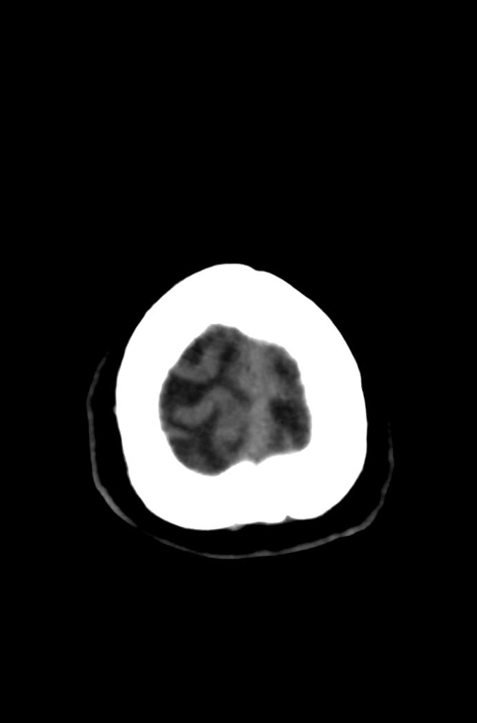 Artery of Percheron infarction (Radiopaedia 80613-94202 Axial non-contrast 182).jpg