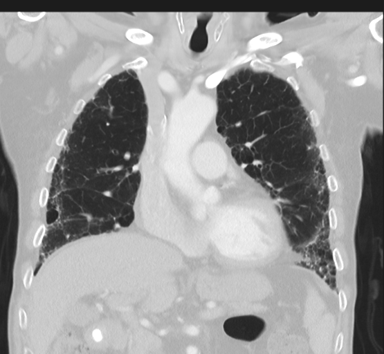 Asbestosis (Radiopaedia 56192-62864 Coronal lung window 21).png