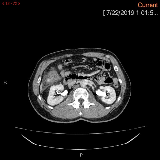 File:Ascending colonic diverticulum mimicking acute appendicitis (Radiopaedia 69943-80198 A 72).jpg