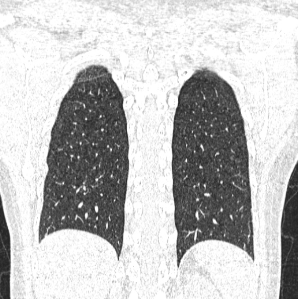 File:Aspergilloma (Radiopaedia 26223-26347 Coronal lung window 44).jpg