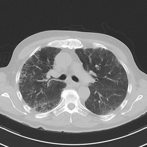 Aspergilloma on background pulmonary fibrosis (Radiopaedia 60942-68757 A 23).jpg
