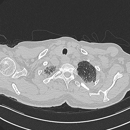 File:Aspergilloma on background pulmonary fibrosis (Radiopaedia 60942-68757 B 8).jpg