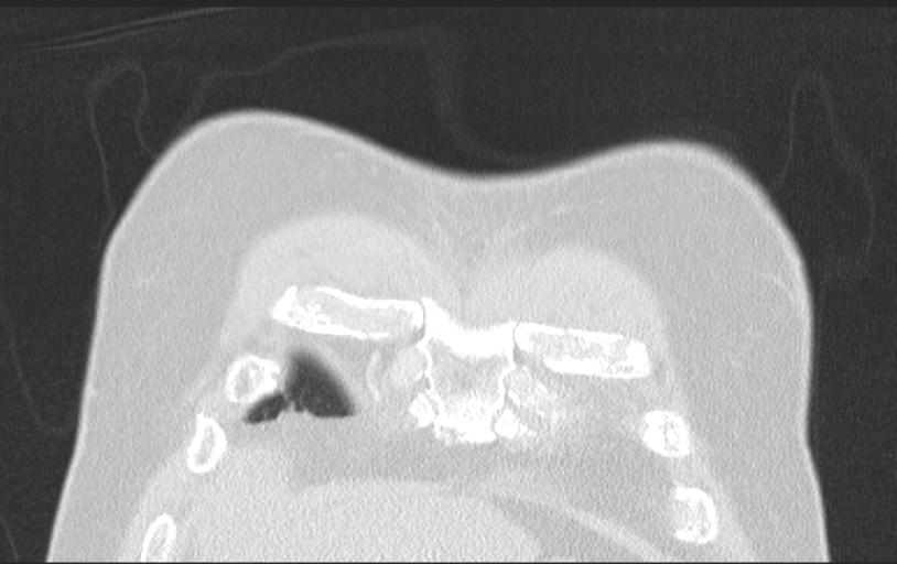 Aspirated tooth (Radiopaedia 28584-28844 Axial lung window 24).jpg