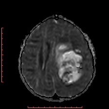 File:Astroblastoma (Radiopaedia 74287-85162 Axial ADC 41).jpg