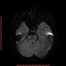 Astroblastoma (Radiopaedia 74287-85162 Axial DWI 27).jpg