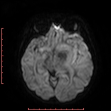 Astroblastoma (Radiopaedia 74287-85162 Axial DWI 44).jpg