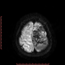 Astroblastoma (Radiopaedia 74287-85162 Axial DWI 98).jpg