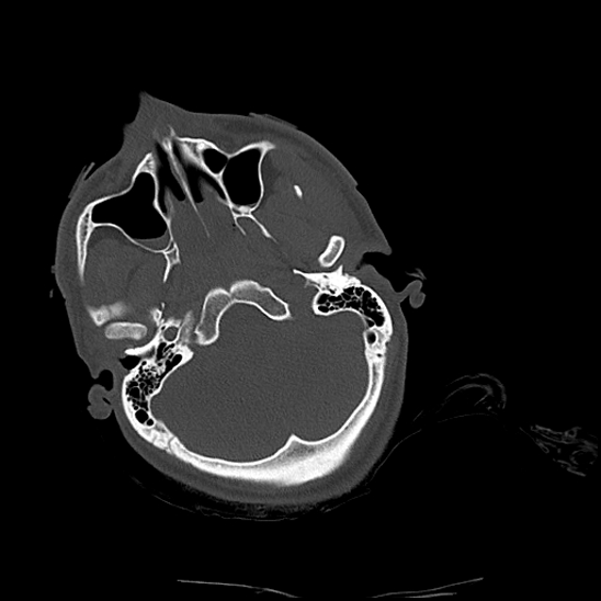 Atlanto-occipital dissociation (Traynelis type 1), C2 teardrop fracture, C6-7 facet joint dislocation (Radiopaedia 87655-104061 Axial bone window 5).jpg