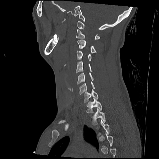 Atlanto-occipital dissociation (Traynelis type 1), C2 teardrop fracture, C6-7 facet joint dislocation (Radiopaedia 87655-104061 Sagittal bone window 43).jpg
