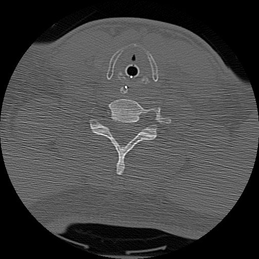 Atlanto-occipital dissociation injury (Radiopaedia 29274-29698 Axial bone window 58).png