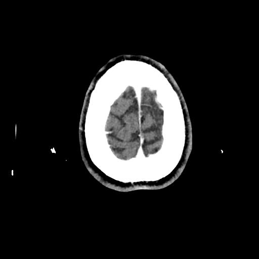 Atretic cephalocele (Radiopaedia 89782-106881 Axial with contrast 173).jpg