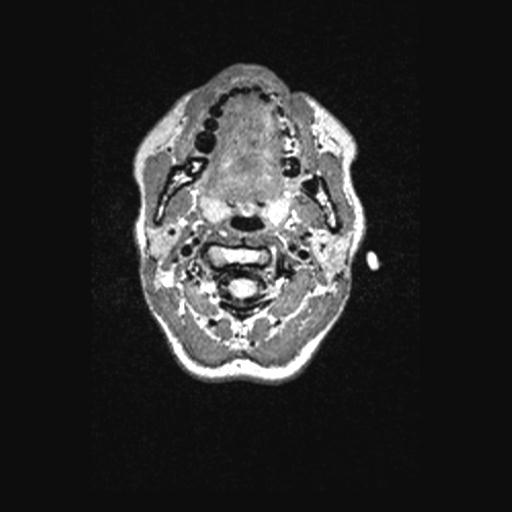 Atretic encephalocoele with inferior vermis hypoplasia (Radiopaedia 30443-31108 Axial 2).jpg