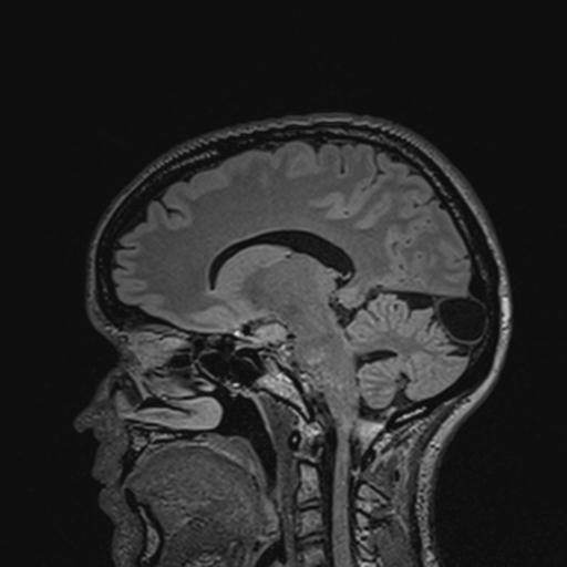 Atretic encephalocoele with inferior vermis hypoplasia (Radiopaedia 30443-31108 Sagittal FLAIR 92).jpg