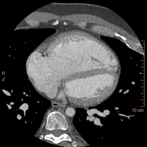 Atrial septal defect (upper sinus venosus type) with partial anomalous pulmonary venous return into superior vena cava (Radiopaedia 73228-83961 A 172).jpg