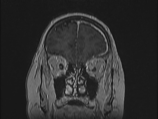 Atypical meningioma (Radiopaedia 62985-71406 Coronal T1 C+ 19).jpg