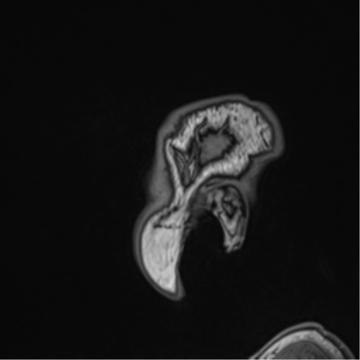 Atypical meningioma (WHO grade II) with brain invasion (Radiopaedia 57767-64729 Sagittal T1 9).png