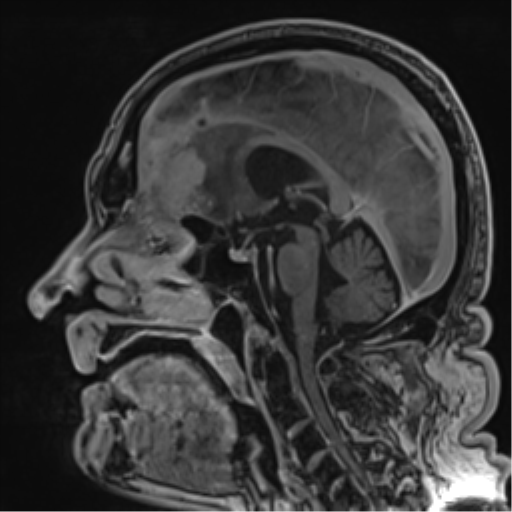 Atypical meningioma (WHO grade II) with brain invasion (Radiopaedia 57767-64729 Sagittal T1 C+ 36).png