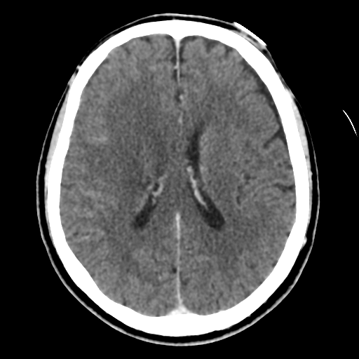 Atypical meningioma (WHO grade II) with osseous invasion (Radiopaedia 53654-59715 Axial C+ delayed 32).png