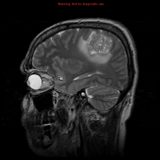 File:Atypical meningioma - grade II (Radiopaedia 13303-13305 Sagittal T2 7).jpg