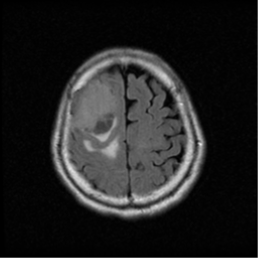 File:Atypical meningioma with skull invasion (Radiopaedia 34357-35648 Axial FLAIR 18).png