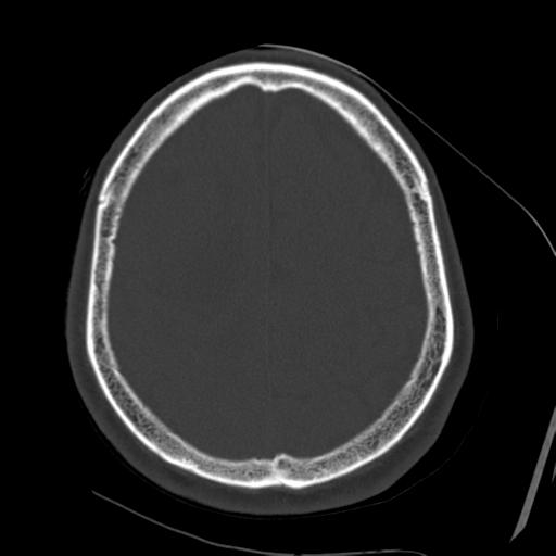 Atypical meningioma with skull invasion (Radiopaedia 34357-35649 Axial bone window 62).png