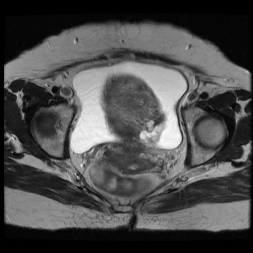 File:Atypical retroperitoneal lymphocoeles with large leiomyoma of uterus (Radiopaedia 32084-33027 Axial T2 24).jpg