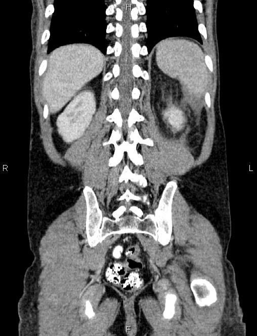 Autoimmune pancreatitis (Radiopaedia 84925-100431 D 50).jpg
