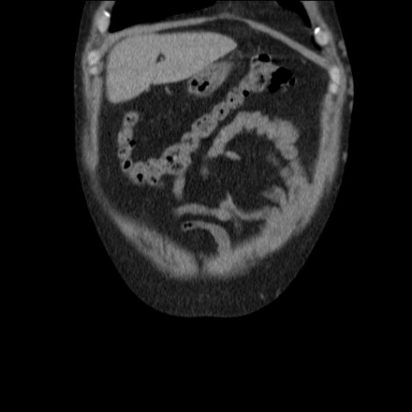 Autosomal dominant polycystic kidney disease (Radiopaedia 36539-38101 C 12).jpg