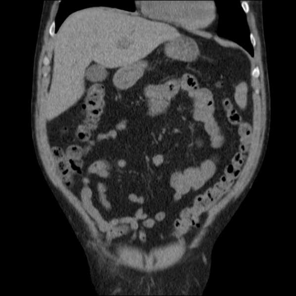 Autosomal dominant polycystic kidney disease (Radiopaedia 36539-38101 C 22).jpg