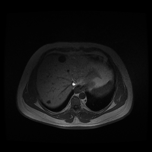 Autosomal dominant polycystic kidney disease (Radiopaedia 50259-55611 Axial 2D Dual Echo 14).jpg