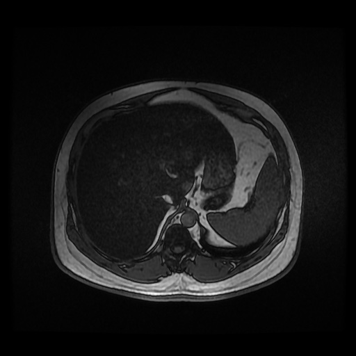 Autosomal dominant polycystic kidney disease (Radiopaedia 50259-55611 Axial 2D Dual Echo 25).jpg