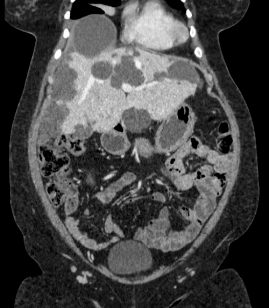 Autosomal dominant polycystic kidney disease (Radiopaedia 57124-64017 B 23).jpg