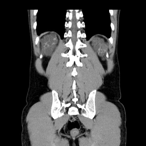 Autosomal dominant polycystic kidney disease (Radiopaedia 66349-75582 A 77).jpg